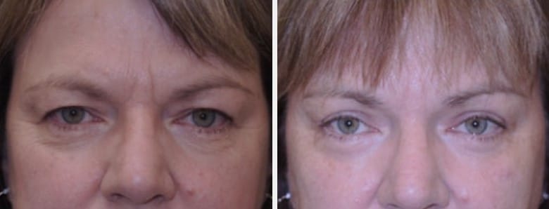 Before and after Blepharoplasty surgery image of a woman's eyes