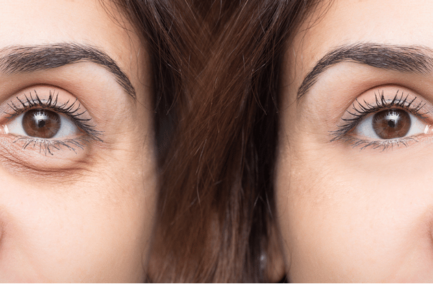 Woman eye before and after cosmetic treatment