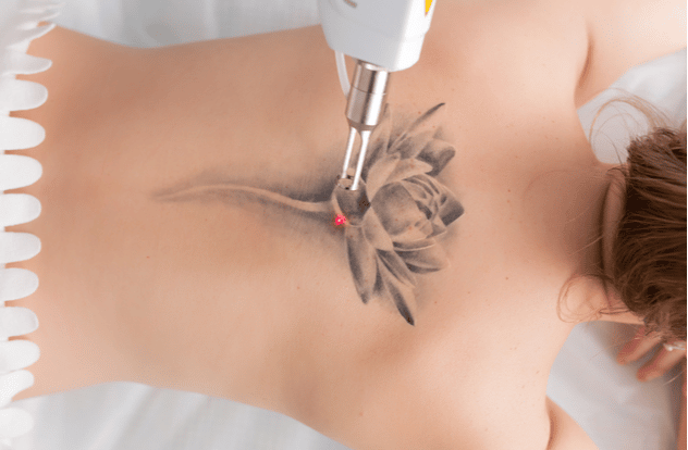 laser tattoo removal from back